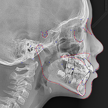 Free 1 month unlimited use With ORCA's AI 3D Segmentation analysis from any CBCT scans!