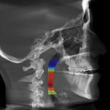 Free 1 month unlimited use Fully automated & Instant CEPHALOMETRIC ANALYSIS ! For Orthodontist